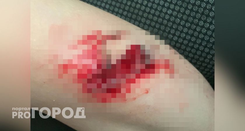 В Кирово-Чепецке ребенок разодрал ногу из-за торчащей "железяки" на детской площадке