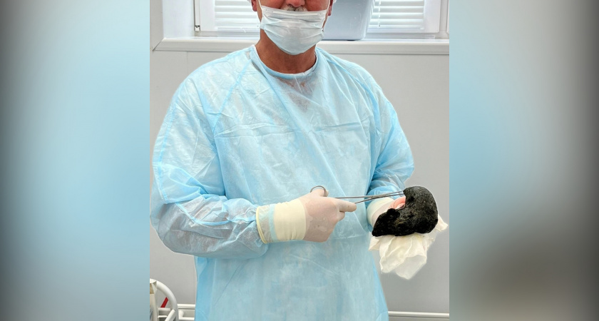 Кировские врачи удалили большие комки волос из желудков двух пациентов