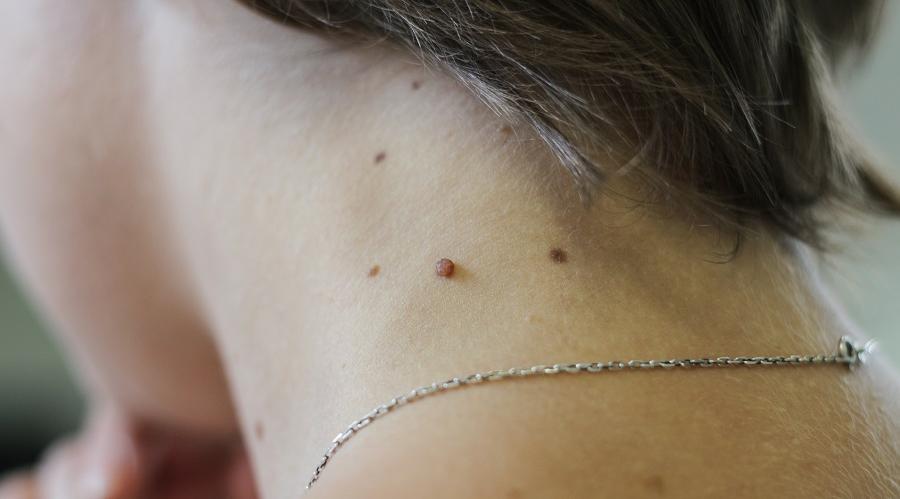 «Клиник Дерм» приглашает на бесплатную проверку папиллом на доброкачественность