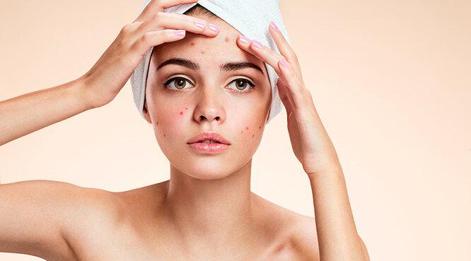 Дерматолог раскрыл причину появления прыщей после новогодних праздников