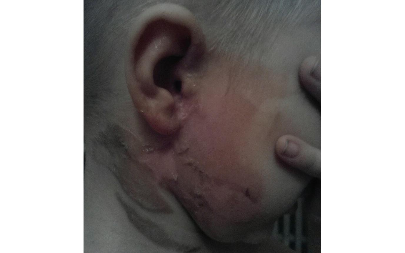 В Чепецке няня пролила на ребенка суп: мальчик получил серьезные ожоги