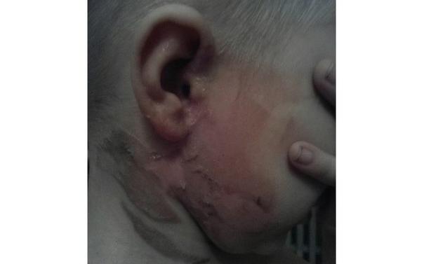 В Чепецке заведующей детского сада, где ребенок получил ожоги, сделано замечание