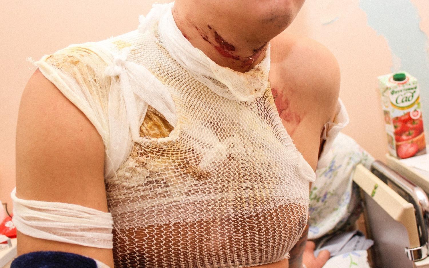 В Кирове мужчина получил 60 процентов ожогов тела