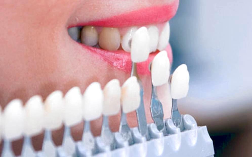 Микропротезирование: 1 сеанс - новая улыбка готова!