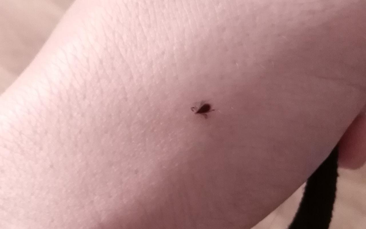 В Кировской области зарегистрирован первый случай нападения клеща на человека в этом сезоне