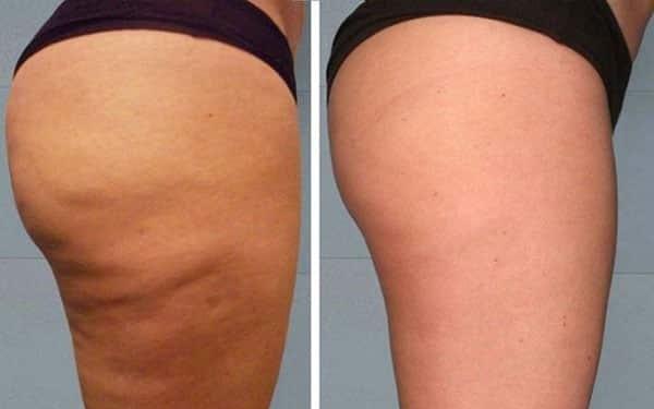 Как обрести стройную талию без тренировок и диет?