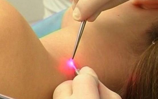 3 главные опасности папилломы