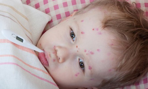 Чепецкие дети массово болеют ветрянкой