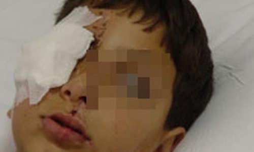 Молодой чепчанин лишил мужчину зрения