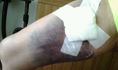 На улице в Кирово-Чепецке женщину искусала собака