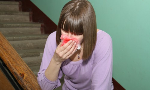 В Кирове в общежитии 25-летняя девушка откусила нос соседке