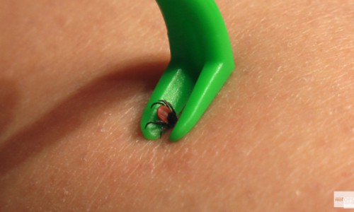 В Кировской области от укусов клещей пострадали более 5 000 человек