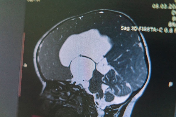 "Вмешались в мозг": в Кировской области врачи спасли малыша с опасной патологией 