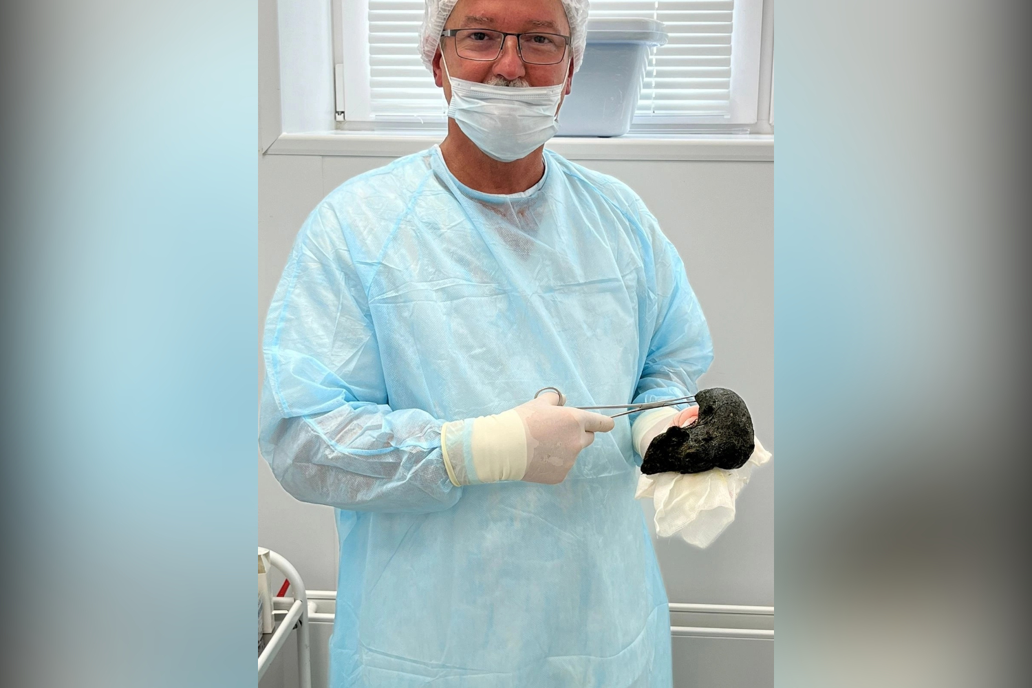 Кировские врачи удалили большие комки волос из желудков двух пациентов